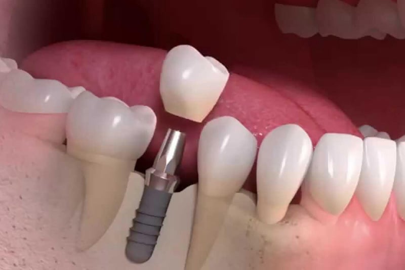 denizli implant